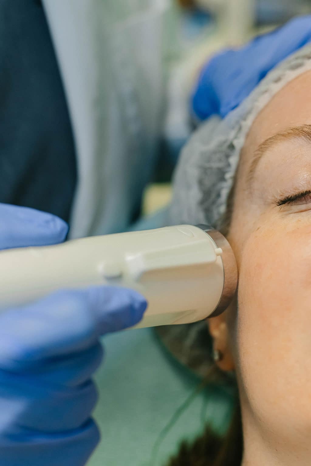 RF Microneedling at Face-Time Aesthetics